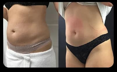 Tummy Result